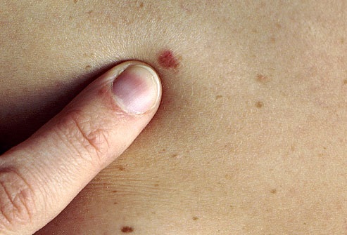 Bőrrák - Betegségek | Budai Egészégközpont