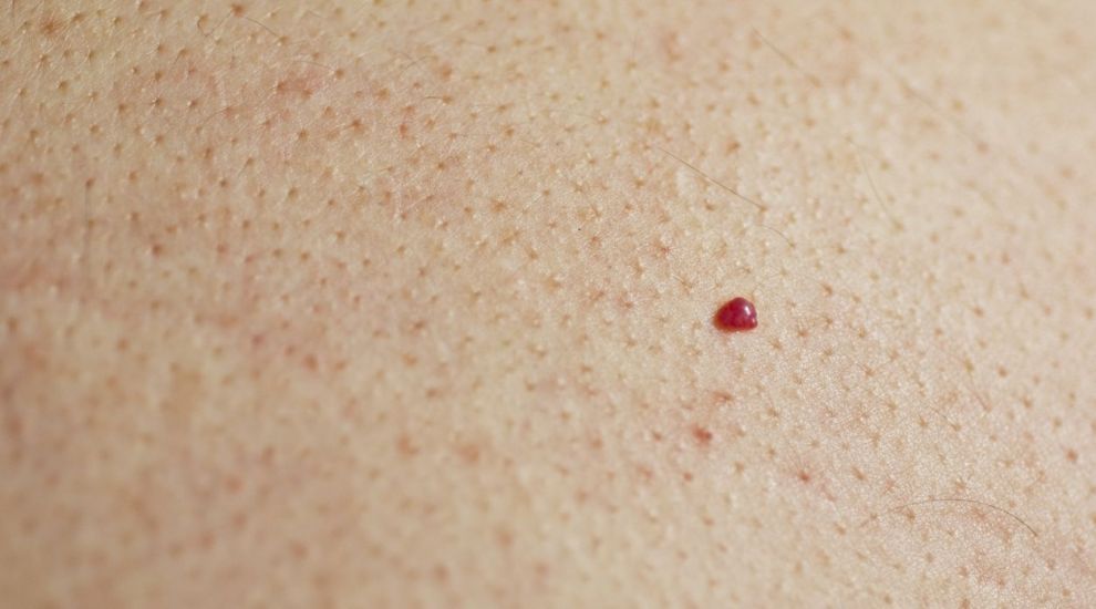 mit jelentenek az emberi bőr piros foltjai